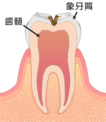 虫歯の中期（歯の中の象牙質の虫歯）